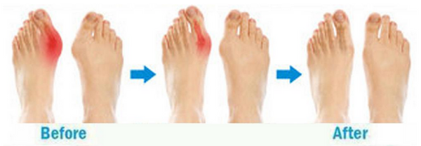 Chaussures Correctives - Sandales Hallux valgus